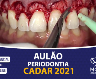 Aulão Periodontia – CADAR 2021